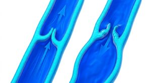 하지정맥 내 판막 부전과 혈액 역류의 의학적 기전을 보여주는 3D 일러스트